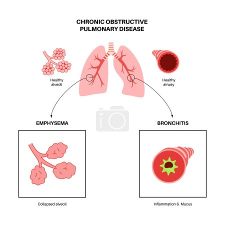 Ilustración de Enfermedad pulmonar obstructiva crónica o EPOC. Grupo de enfermedades pulmonares. Problema con las vías respiratorias y los sacos de aire, moco en los pulmones, alvéolos colapsados. Enfermedad del sistema respiratorio humano ilustración vectorial plana - Imagen libre de derechos