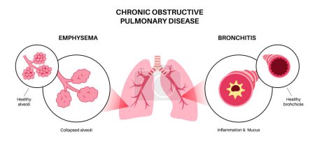 Ilustración de Enfermedad pulmonar obstructiva crónica o EPOC. Grupo de enfermedades pulmonares. Problema con las vías respiratorias y los sacos de aire, moco en los pulmones, alvéolos colapsados. Enfermedad del sistema respiratorio humano ilustración vectorial plana - Imagen libre de derechos