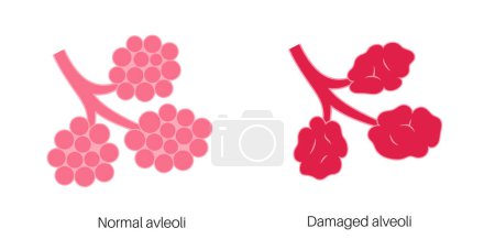 Illustration for Emphysema disease concept. Damaged alveoli, failure airway. Floppy walls between air sacs in human lungs. Shortness of breath, chest tightness. Illness of respiratory system flat vector illustration - Royalty Free Image