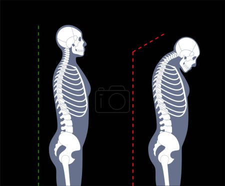 Diagrama de deformación de las vértebras cervicales. Espasmos en el cuello, dolor en la columna vertebral, rigidez y opresión en los hombros. Espina dorsal sana y joroba en la ilustración del vector médico del cuerpo masculino, silueta del esqueleto.