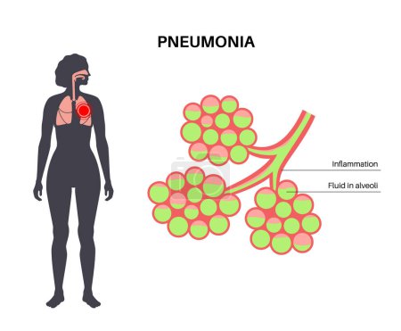 Pneumonia infection anatomical poster. Inflammation in the human respiratory system. Alveoli with fluid. Disease in lungs, purulent material in chest. Difficult breathing and cough vector illustration