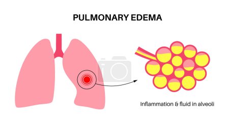 Cartel anatómico de edema pulmonar. Líquido anormal en los pulmones. Inflamación en el sistema respiratorio humano. Alvéolos con líquido. Material purulento en el pecho. Falta de aliento y causas de tos