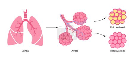 Lungenentzündung Infektion anatomisches Plakat. Entzündung der menschlichen Atemwege. Alveolen mit Flüssigkeit. Krankheit in der Lunge, eitriges Material in der Brust. Atembeschwerden und Hustenreiz