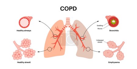 Chronic obstructive pulmonary disease or COPD. Group of lung disease. Problem with airways and air sacs, mucus in lungs, collapsed alveoli. Illness of human respiratory system flat vector illustration