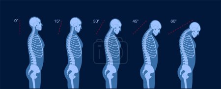 Diagrama de deformación de las vértebras cervicales. Espasmos en el cuello, dolor en la columna vertebral, rigidez y opresión en los hombros. Espina dorsal sana y joroba en la ilustración del vector médico del cuerpo masculino, silueta del esqueleto.