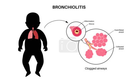 Bronchiolitis infection in young child body. Viral infection of lungs in the infant silhouette. Inflammation and mucus in the airways. Lung disease, pain in chest and cough flat vector illustration.