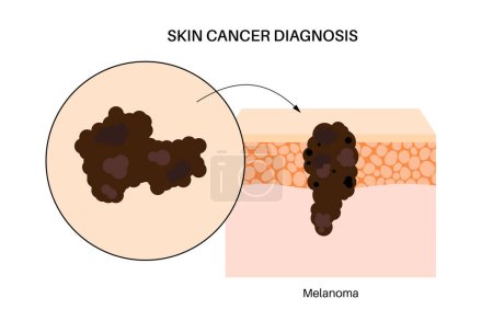 Cartel anatómico de melanoma, desarrollo de cáncer de piel. Crecimiento tumoral maligno en las capas de la piel desde la epidermis hasta otros órganos internos. Diagnóstico y tratamiento en clínica de dermatología vector plano