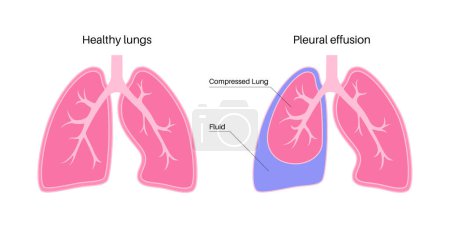 Pleural effusion disease. Fluid between the layers of tissue in lungs and chest cavity. DIfficult breathing. Unhealthy internal organs in the human body. Respiratory system medical vector illustration