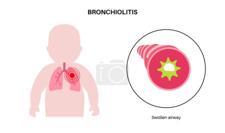 Ilustración de Infección por bronquiolitis en el cuerpo del niño pequeño. Infección viral de los pulmones en la silueta infantil. Inflamación y mucosidad en las vías respiratorias. Enfermedad pulmonar, dolor en el pecho y tos ilustración vectorial plana. - Imagen libre de derechos