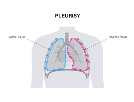 Illustration for Pleurisy disease concept. Inflammation in lungs. Sharp chest pain during breathing. Unhealthy internal organs in the human body. Chest cavity problem. Respiratory system poster vector illustration. - Royalty Free Image