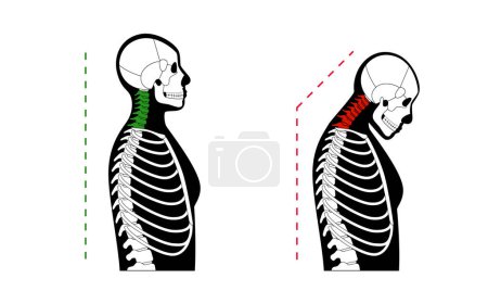 Schéma de déformation des vertèbres cervicales. Spasme au cou, douleur dans la colonne vertébrale, raideur et oppression dans les épaules. Colonne vertébrale et bosse saines dans le corps masculin illustration vectorielle médicale, silhouette squelette.