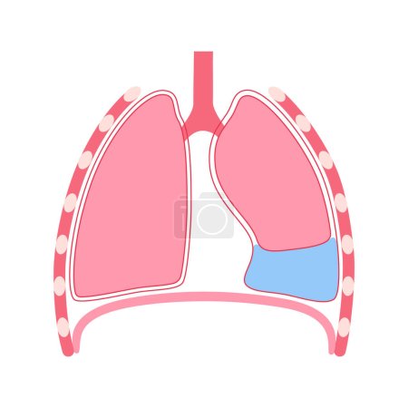 Illustration for Pleural effusion disease. Fluid between the layers of tissue in lungs and chest cavity. DIfficult breathing. Unhealthy internal organs in the human body. Respiratory system medical vector illustration - Royalty Free Image