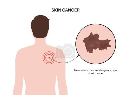 Melanoma en la espalda de un hombre, desarrollo de cáncer de piel. Diagnóstico y tratamiento de tumores malignos. Pigmento que produce células melanocitarias. Examen dermatológico en laboratorio ilustración vectorial plana