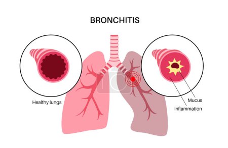 Bronchitis, Lungenentzündung. Bronchi anatomisches Plakat. Gereizte, geschwollene und entzündete Atemwege. Atembeschwerden, Husten, Brustschmerzen und Schleim in der Lunge.