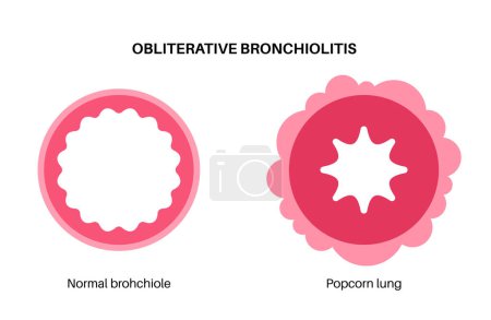 Ilustración de Infección por bronquiolitis en el cuerpo del niño pequeño. Infección viral de los pulmones. Órgano interno recién nacido. Inflamación, hinchazón y moco en las vías respiratorias. Enfermedad pulmonar, dolor en el pecho ilustración vector plano. - Imagen libre de derechos