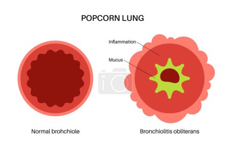 Ilustración de Infección por bronquiolitis en el cuerpo del niño pequeño. Infección viral de los pulmones. Órgano interno recién nacido. Inflamación, hinchazón y moco en las vías respiratorias. Enfermedad pulmonar, dolor en el pecho ilustración vector plano. - Imagen libre de derechos