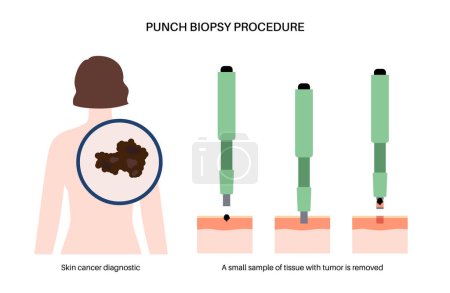 Punch biopsy procedure. Cutting tissue from the surface of the body. Malignant tumor cells tested in a laboratory. Instrument removes specimen from epidermis layer. Skin cancer condition examination.