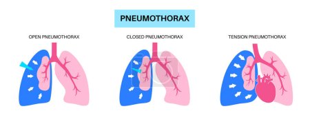 Téléchargez les illustrations : Pneumothorax maladie plat vecteur. Affiche médicale pulmonaire effondrée. Air dans l'espace entre poumon et paroi thoracique. Douleur thoracique, essoufflement. Organes internes malsains dans le système respiratoire - en licence libre de droit