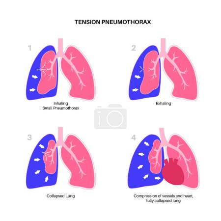 Spannungspneumothorax-Erkrankung. Die Verringerung der Blutmenge kehrte zum Herzen zurück. Lungen- oder Brustwandverletzungen. Brustschmerzen, Atemnot. Ungesunde innere Organe im Atemwegsvektor