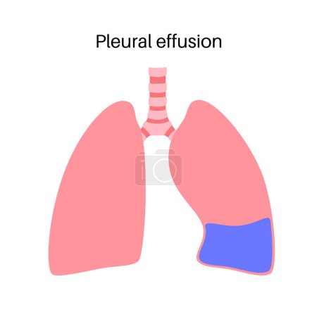 Illustration for Pleural effusion disease. Fluid between the layers of tissue in lungs and chest cavity. DIfficult breathing. Unhealthy internal organs in the human body. Respiratory system medical vector illustration - Royalty Free Image