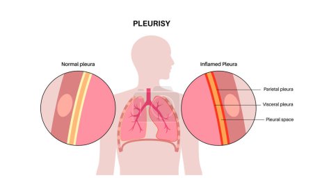Pleurisy disease concept. Inflammation in lungs. Sharp chest pain during breathing. Unhealthy internal organs in the human body. Chest cavity problem. Respiratory system poster vector illustration.