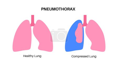 Pneumothorax maladie plat vecteur. Affiche médicale pulmonaire effondrée. Air dans l'espace entre poumon et paroi thoracique. Douleur thoracique, essoufflement. Organes internes malsains dans le système respiratoire