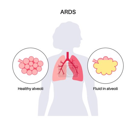 Síndrome de dificultad respiratoria aguda. Los pulmones no tienen suficiente oxígeno. Cartel médico de ARDS. Etapas exudativas, proliferativas y fibróticas. Órganos internos poco saludables. Sistema respiratorio vector ilustración