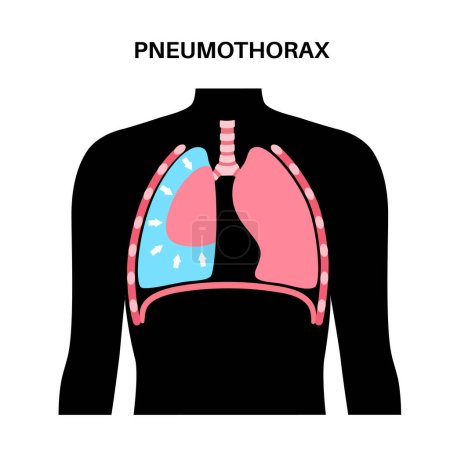 Enfermedad del neumotórax vector plano. Cartel médico pulmonar colapsado. Aire en el espacio entre el pulmón y la pared torácica. Dolor torácico, falta de respiración. Órganos internos poco saludables en el sistema respiratorio