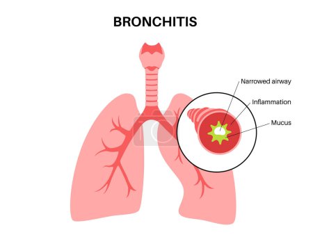 Ilustración de Concepto de bronquitis, infección de los pulmones. Cartel anatómico de Bronchi. Irritado, hinchazón e inflamación de las vías respiratorias. Dificultad para respirar, tos, dolor torácico y mucosidad en los pulmones ilustración vectorial plana. - Imagen libre de derechos