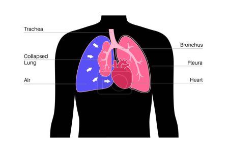 Ilustración de Enfermedad por neumotórax por tensión. Reducir la cantidad de sangre devuelta al corazón. Lesión pulmonar o en la pared torácica. Dolor torácico, falta de respiración. Órganos internos no saludables en el vector del sistema respiratorio - Imagen libre de derechos