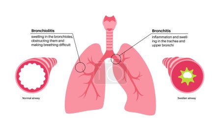 Ilustración de Bronquitis y bronquiolitis, infección de los pulmones. Cartel anatómico de Bronchi. Irritado, hinchazón e inflamación de las vías respiratorias. Dificultad para respirar, tos, dolor torácico y mucosidad en los pulmones ilustración vectorial - Imagen libre de derechos