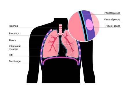 Illustration for Pleura anatomy concept. Chest cavity medical poster. Membrane tissue in human body. Respiration system scheme. Pulmonary pleurae diagram. Lungs, trachea, bronchi and ribs flat vector illustration. - Royalty Free Image