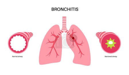 Téléchargez les illustrations : Concept de bronchite, infection des poumons. Affiche anatomique Bronchi. Irritation, gonflement et inflammation des voies respiratoires. Difficulté à respirer, toux, douleurs thoraciques et mucus dans les poumons illustration vectorielle plate. - en licence libre de droit