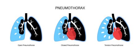 Ilustración de Enfermedad del neumotórax vector plano. Cartel médico pulmonar colapsado. Aire en el espacio entre el pulmón y la pared torácica. Dolor torácico, falta de respiración. Órganos internos poco saludables en el sistema respiratorio - Imagen libre de derechos