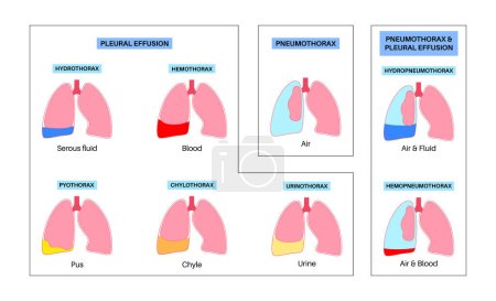 Illustration for Pleural effusion poster. Fluid between the layers of tissue in lungs and chest cavity. Common lungs diseases. Cough, chest pain, difficulty breathing. Unhealthy internal organs in respiratory system - Royalty Free Image
