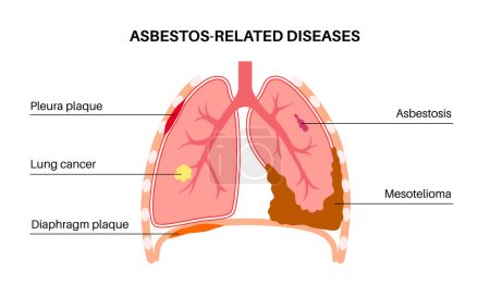 Asbestbedingte Krankheiten. Pleura- und Membranbelag, Lungenkrebs, Asbestose und Mesotheliom-Tumorzellen. Atemwegserkrankungen. Kurzatmigkeit, Schmerzen im Brustbereich.