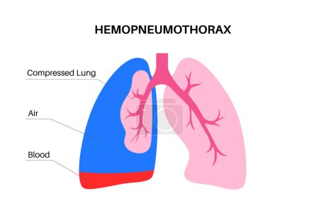 Hemopneumotórax enfermedad pulmonar. Combinación de dos condiciones médicas neumotórax y hemotórax. Tos, dolor en el pecho, dificultad para respirar. Órganos internos poco saludables. Ilustración del sistema respiratorio