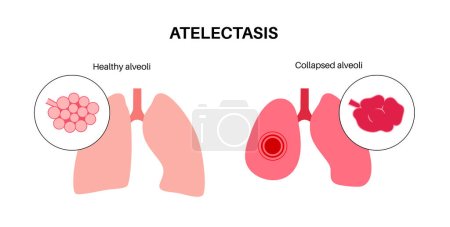 Atelectasis disease anatomical poster. Complete or partial collapse or closure of a lung. Reduced or absent gas exchange. Lungs filled with alveolar fluid. Respiratory system flat vector illustration