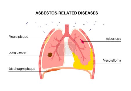 Illustration for Asbestos related diseases. Pleura and diaphragm plaque, lung cancer, asbestosis, and mesothelioma tumor cells. Respiratory system illness. Shortness of breath, pain in chest flat vector illustration. - Royalty Free Image