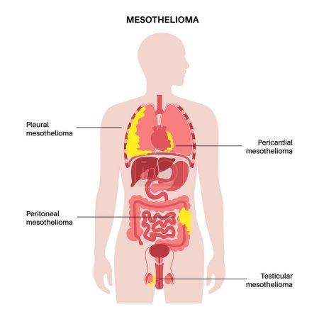 Arten von Mesotheliom-Tumoren. Krebszellen breiten sich in Lunge, Herz, Darm und Hoden aus. Pleura-, Perikard-, Peritoneal- und Hodenmesotheliom. Asbestbedingte Krankheiten Vektor Illustration