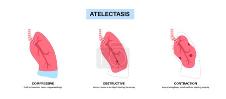 Cartel anatómico de la enfermedad de Atelectasis. Colapso total o parcial o cierre de un pulmón. Intercambio de gas reducido o ausente. Pulmones llenos de líquido alveolar. Sistema respiratorio ilustración vectorial plana