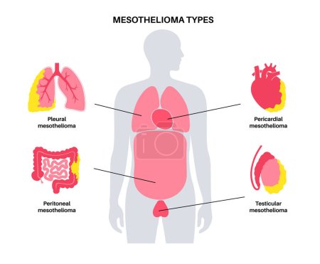 Types of mesothelioma tumor. Cancer cells spreading in lung, heart, intestine and testicles. Pleural, pericardial, peritoneal and testicular mesothelioma. Asbestos related diseases vector illustration