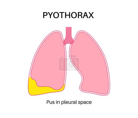 Ilustración de Piotórax y empiema pleural. Enfermedad inflamatoria pulmonar. Infección en la cavidad torácica y el área del corazón. Dolor torácico, dificultad para respirar. Órgano interno insalubre. Pus o bacterias en el sistema respiratorio - Imagen libre de derechos