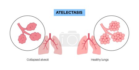 Illustration for Atelectasis disease anatomical poster. Complete or partial collapse or closure of a lung. Reduced or absent gas exchange. Lungs filled with alveolar fluid. Respiratory system flat vector illustration - Royalty Free Image