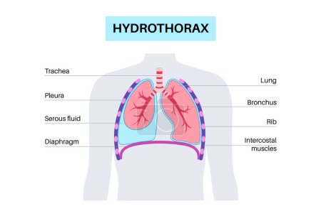 Illustration for Hydrothorax lungs disease. Noninflammatory serous fluid collection in pleural cavity. Severe cough, chest pain, difficulty breathing. Unhealthy internal organs. Respiratory system vector illustration - Royalty Free Image