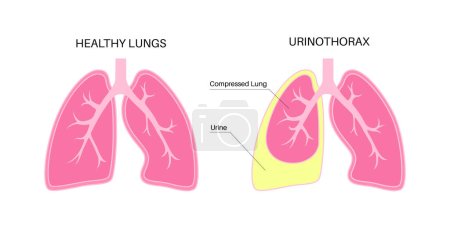 Ilustración de Enfermedad urinotórax. La orina se acumula en la cavidad llena de líquido en los pulmones. Dolor torácico, dificultad para respirar y otros problemas en el concepto del sistema respiratorio. Ilustración de vectores de órganos internos poco saludables - Imagen libre de derechos