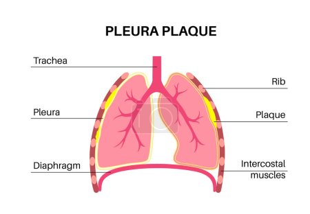 Illustration for Pleural plaque medical poster. Asbestos related lungs disease. Thickened tissue in the human body, respiratory system illness. Difficulty breathing, bloody cough, chest pain flat vector illustration. - Royalty Free Image