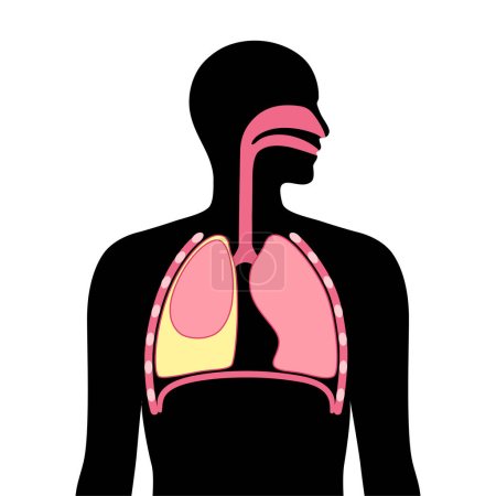 Illustration for Chylothorax disease. Lymphatic fluid between layers of tissue in lungs and chest wall. Severe cough, chest pain, difficulty breathing. Unhealthy internal organs. Respiratory system vector illustration - Royalty Free Image