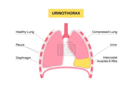 Illustration for Urinothorax disease. Urine collects in fluid-filled cavity in lungs. Chest pain, difficulty breathing and other problems in respiratory system concept. Unhealthy internal organs vector illustration - Royalty Free Image