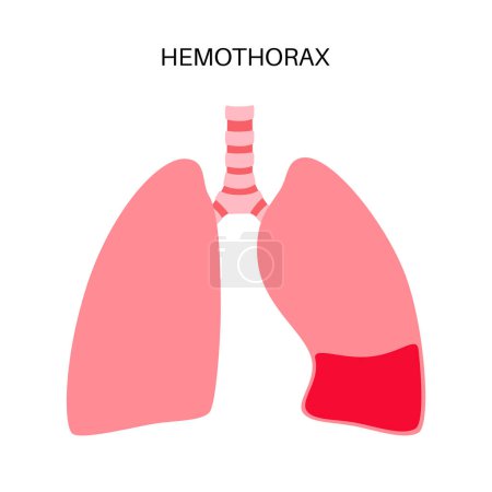 Téléchargez les illustrations : Maladie de l'hémothorax. Le sang s'accumule dans la cavité pleurale. Affaissement des poumons, échec et désordre. Toux sévère, douleurs thoraciques, difficultés respiratoires. Organes internes malsains. Illustration du système respiratoire - en licence libre de droit